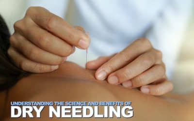 Understanding the Science and Benefits of Dry Needling